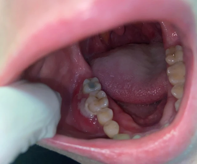 Lesão na região mandibular, caso Jennifer