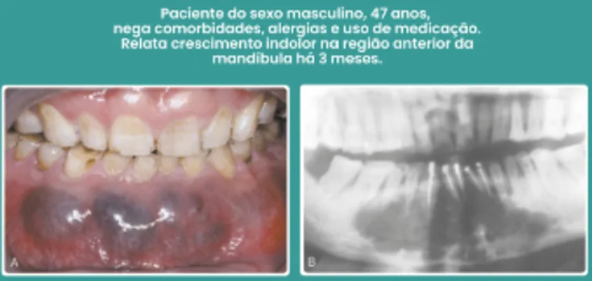 Caso clínico — lesão mandibular